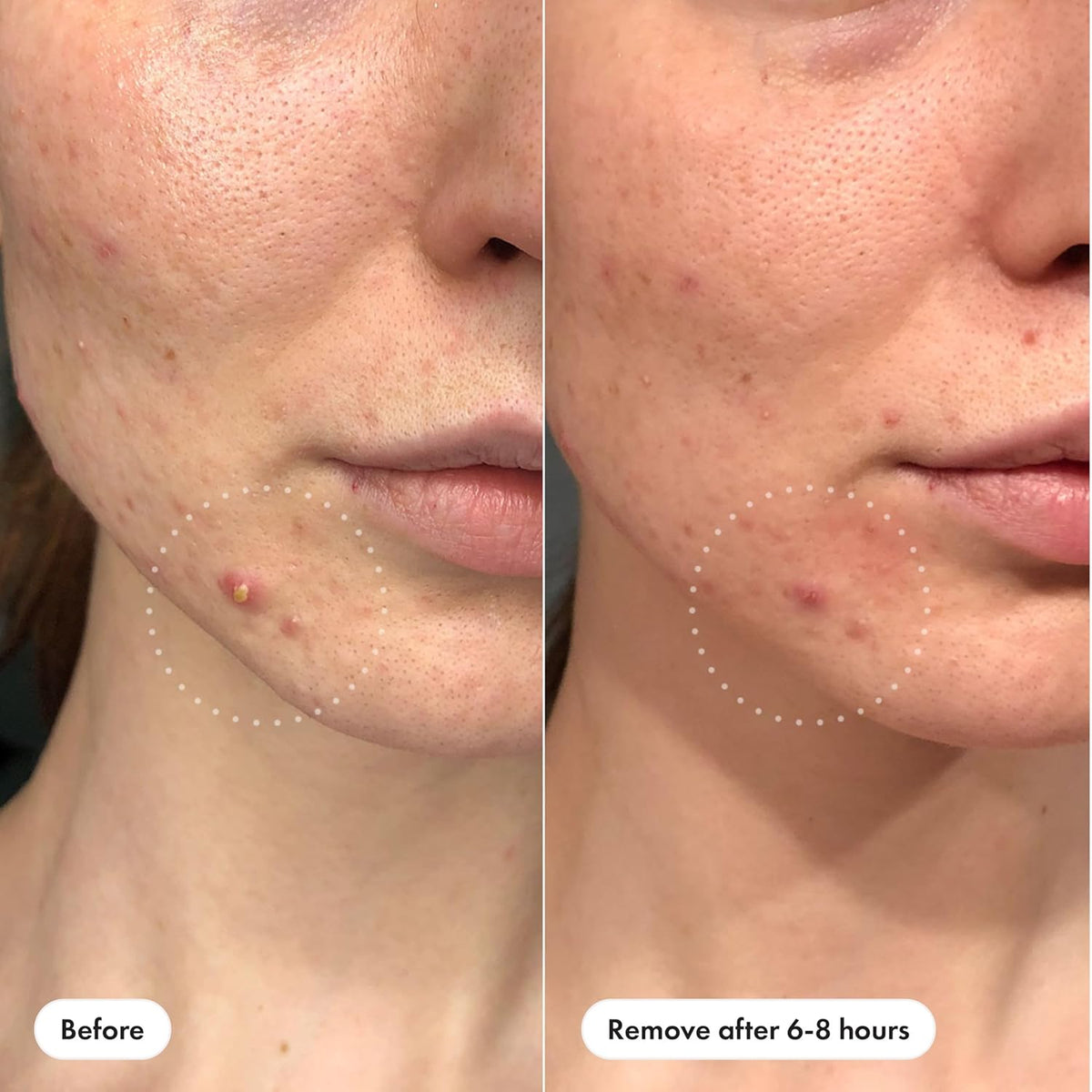 Mighty Patch‰ã¢ Invisible+ Patch ‰ÛÒ The Barely-There Daytime Hydrocolloid Acne Pimple Patch for Covering Zits and Blemishes, Tapered Edges Designed to Blend Into Skin (72ct)